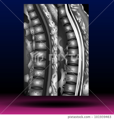 X-ray Myelography X-ray Myelography 101939463