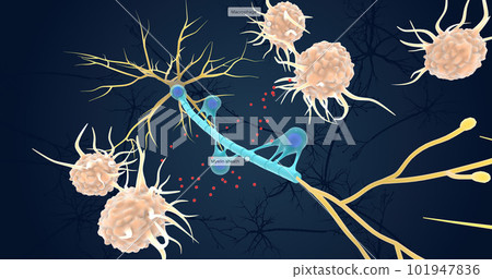 Autoimmune Attack on Myelin Sheath 101947836