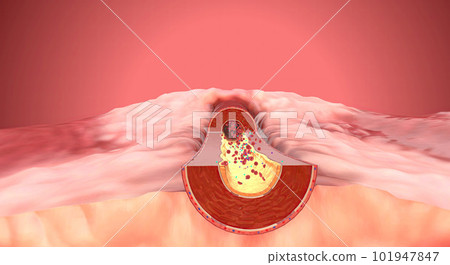 Due to increase of sodium and aldosterone in the blood artery constrict 101947847