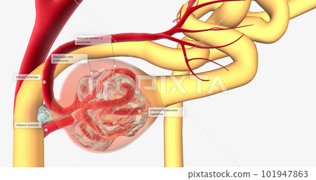 Glomerulonephritis is a group of renal conditions characterized by inflammation of the glomeruli within the kidney. 101947863