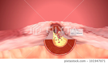 Due to increase of sodium and aldosterone in the blood artery constrict 101947871