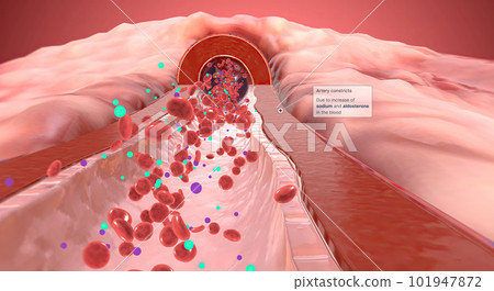 Due to increase of sodium and aldosterone in the blood artery constrict 101947872