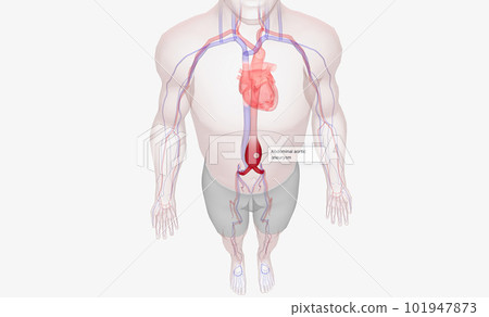 Abdominal aortic aneurysm occurs when the abdominal aorta balloons out due to the weakening of the wall of the artery. Abdominal aortic aneurysm occurs when the abdominal aorta balloons out due to the weakening of the wall of the artery. 101947873