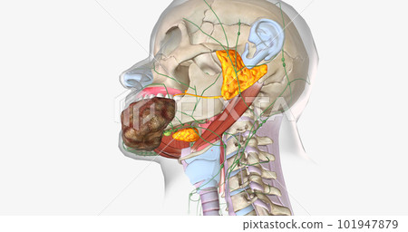 Stage four oral cancer is invasive and has spread beyond the tissue in which it first appeared. Stage four oral cancer is invasive and has spread beyond the tissue in which it first appeared. 101947879