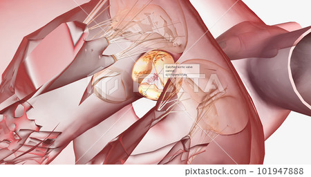 Calcified aortic valve cannot open completely 101947888