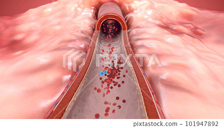 Blood clot begins to form, and is broken up by medication 101947892