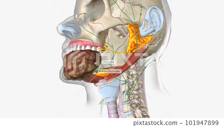 Stage four oral cancer is invasive and has spread beyond the tissue in which it first appeared. Stage four oral cancer is invasive and has spread beyond the tissue in which it first appeared. 101947899