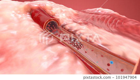 A blood clot is red blood cells that stick together in the bloodstream and are held in place by fibrin. 101947904
