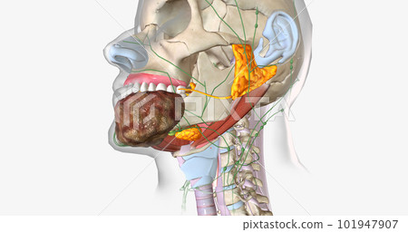 Stage four oral cancer is invasive and has spread beyond the tissue in which it first appeared. Stage four oral cancer is invasive and has spread beyond the tissue in which it first appeared. 101947907