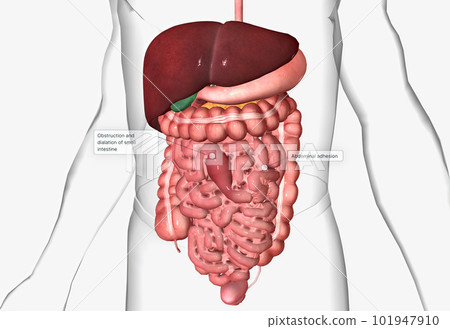 Abdominal adhesions, also called small intestine or GI adhesions Abdominal adhesions, also called small intestine or GI adhesions 101947910