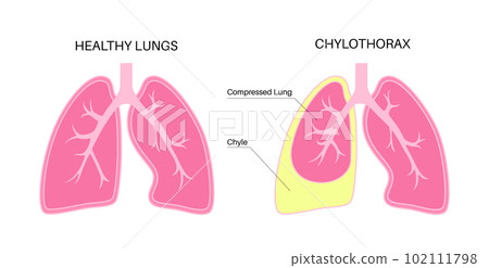 Chylothorax anatomical poster 102111798