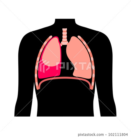 Hemothorax medical poster 102111804