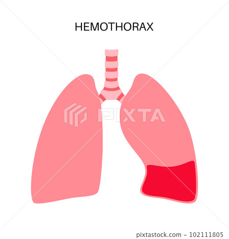 Hemothorax medical poster 102111805