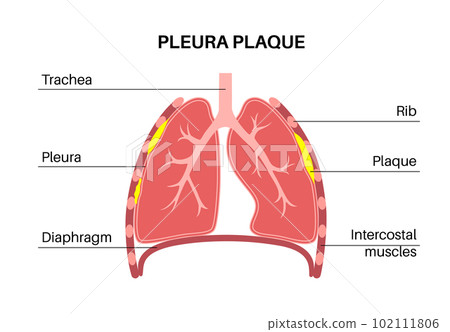 Pleural plaque poster 102111806