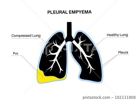 Pyothorax pleural empyema Pyothorax pleural empyema 102111808