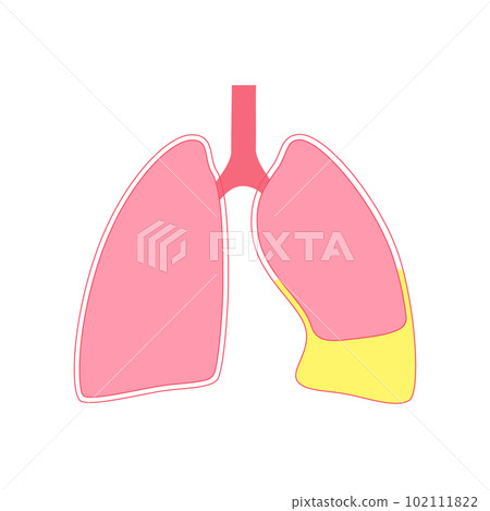 Chylothorax anatomical poster 102111822
