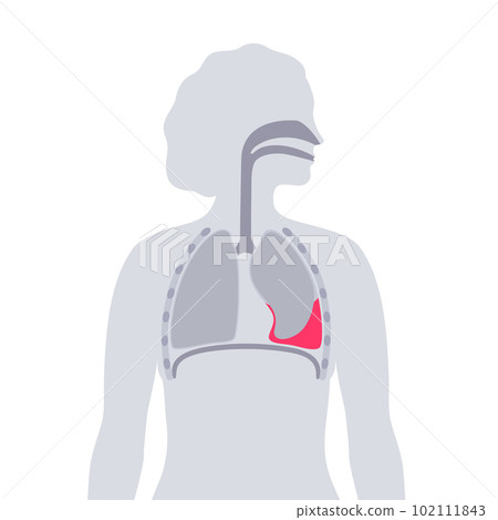 Hemothorax medical poster 102111843