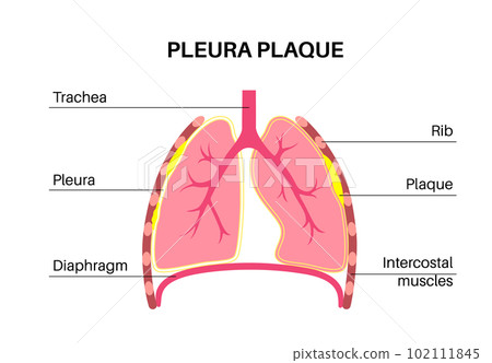 Pleural plaque poster 102111845