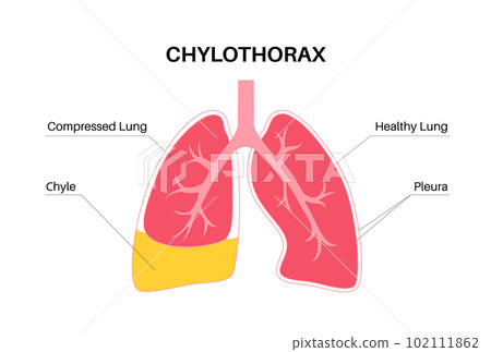 Chylothorax anatomical poster 102111862