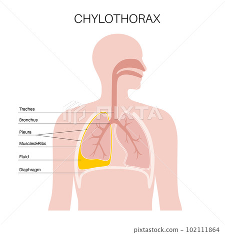 Chylothorax anatomical poster Chylothorax anatomical poster 102111864