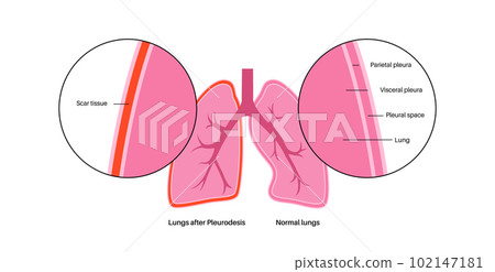 Pleurodesis medical procedure 102147181