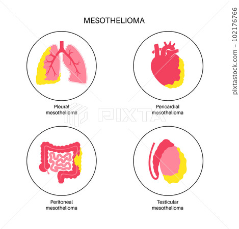 Mesothelioma tumor types Mesothelioma tumor types 102176766