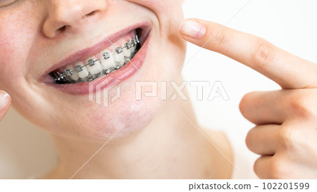 Close-up portrait of a young woman pointing at a smile with braces on her teeth. 102201599