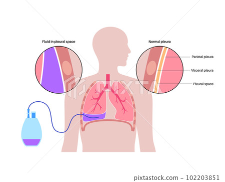 Tunneled pleural catheter 102203851