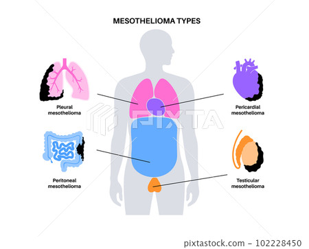 Mesothelioma tumor types 102228450