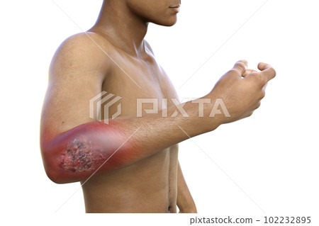 Protothecosis infection on human arm, 3D illustration Protothecosis infection on human arm, 3D illustration 102232895