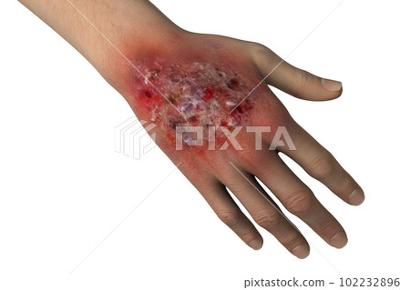 Protothecosis infection on human hand, 3D illustration 102232896