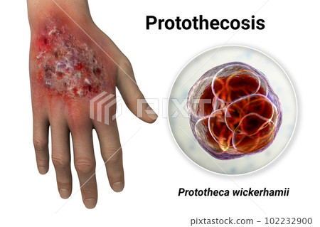 Protothecosis infection on human hand and close-up view of Prototheca wickerhamii green algae, 3D illustration 102232900