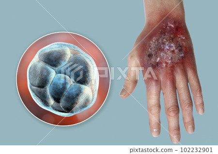 Protothecosis infection on human hand and close-up view of Prototheca wickerhamii green algae, 3D illustration 102232901