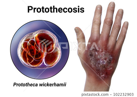Protothecosis infection on human hand and close-up view of Prototheca wickerhamii green algae, 3D illustration 102232903