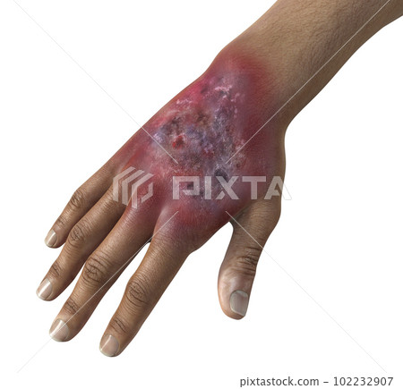 Protothecosis infection on human hand, 3D illustration 102232907
