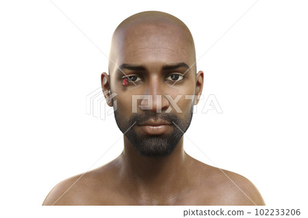 Ocular rhinosporidiosis in a patient, 3D illustration. A disease caused by Rhinosporidium seeberi parasite 102233206