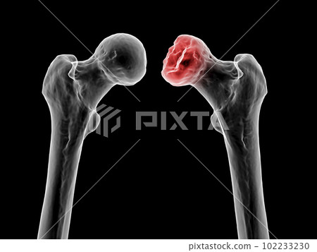 Femur bone affected by Legg-Calve-Perthes Disease, a childhood hip disorder, 3D illustration Femur bone affected by Legg-Calve-Perthes Disease, a childhood hip disorder, 3D illustration 102233230