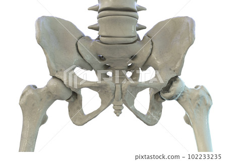 Femur bone affected by Legg-Calve-Perthes Disease, a childhood hip disorder, 3D illustration 102233235