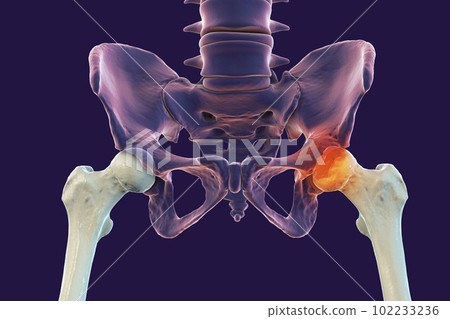 Femur bone affected by Legg-Calve-Perthes Disease, a childhood hip disorder, 3D illustration 102233236