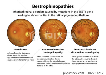 Bestrophinopathies, inherited retinal disorders caused by mutations in the BEST1 gene, illustration 102233247