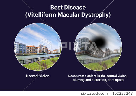The difference between the vision of a normal eye and an eye affected by Best disease, illustration 102233248