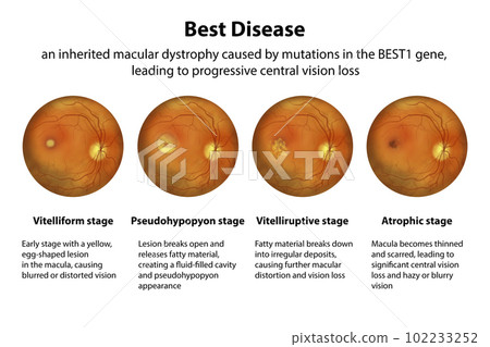 Stages of Best vitelliform macular dystrophy, illustration 102233252