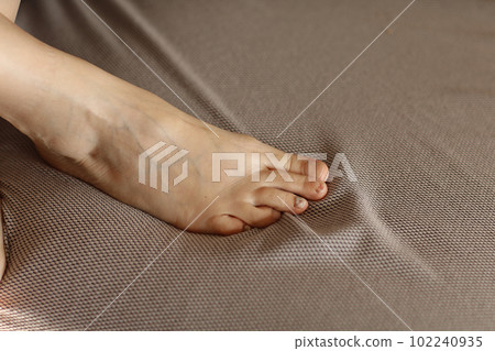 Person feet with subungual hematoma, black toenails caused by trauma, fungal infection or chemotherapy . Female suffering from onychomycosis, a fungal infection causing yellowing of the toenail. 102240935