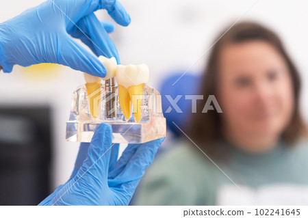Dental implant model in modern clinic: showing teeth implantation and crown, healthy teeth treatments.  102241645
