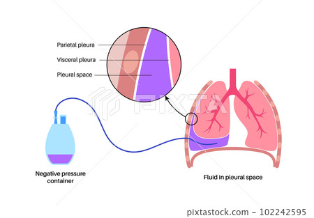 Tunneled pleural catheter 102242595