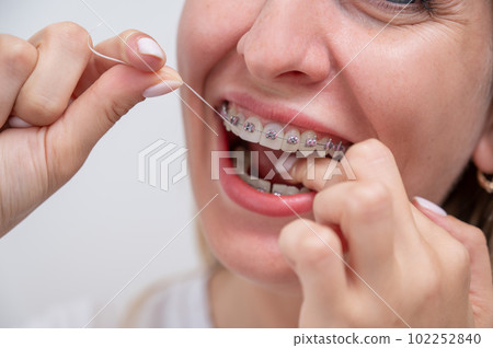 Caucasian woman cleaning her teeth with braces using dental floss. Cropped portrait. Caucasian woman cleaning her teeth with braces using dental floss. Cropped portrait. 102252840