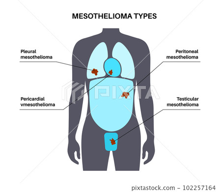 Mesothelioma tumor types Mesothelioma tumor types 102257164