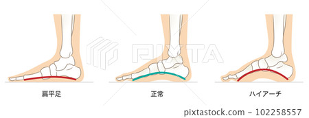 Normal and abnormal foot arches Normal and abnormal foot arches 102258557