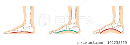 Normal and abnormal foot arches Normal and abnormal foot arches 102258559