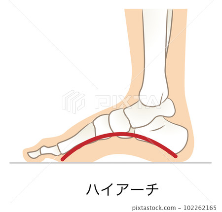 足弓太高,足弓高 102262165
